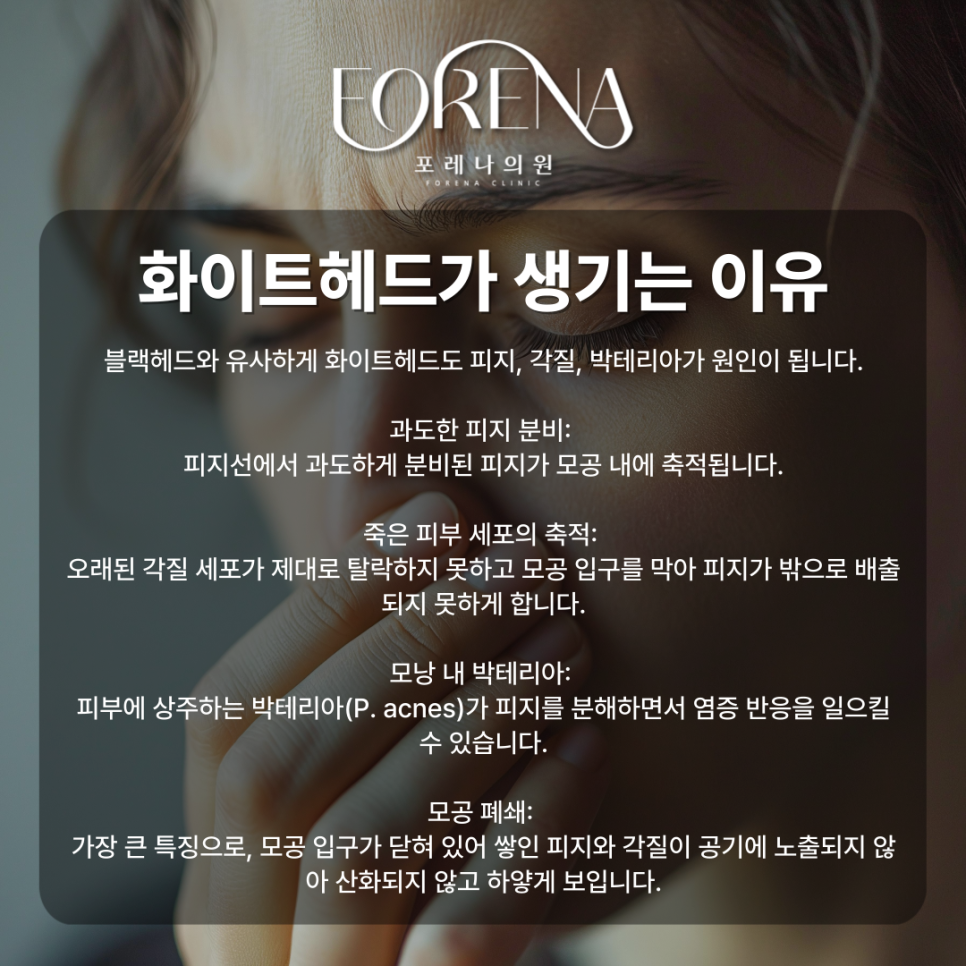 화이트헤드가 대체 뭐야? 블랙헤드랑 비슷한건가? 화이트헤드 설명해드립니다. 관련 이미지 4