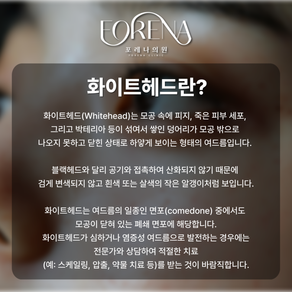 화이트헤드가 대체 뭐야? 블랙헤드랑 비슷한건가? 화이트헤드 설명해드립니다. 관련 이미지 3