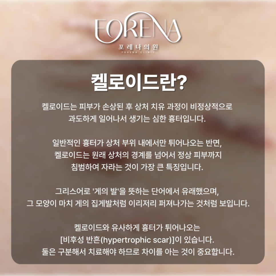 상처(흉터)가 점점 커지고 밖으로 튀어나오는 켈로이드 체질 관련 이미지 3