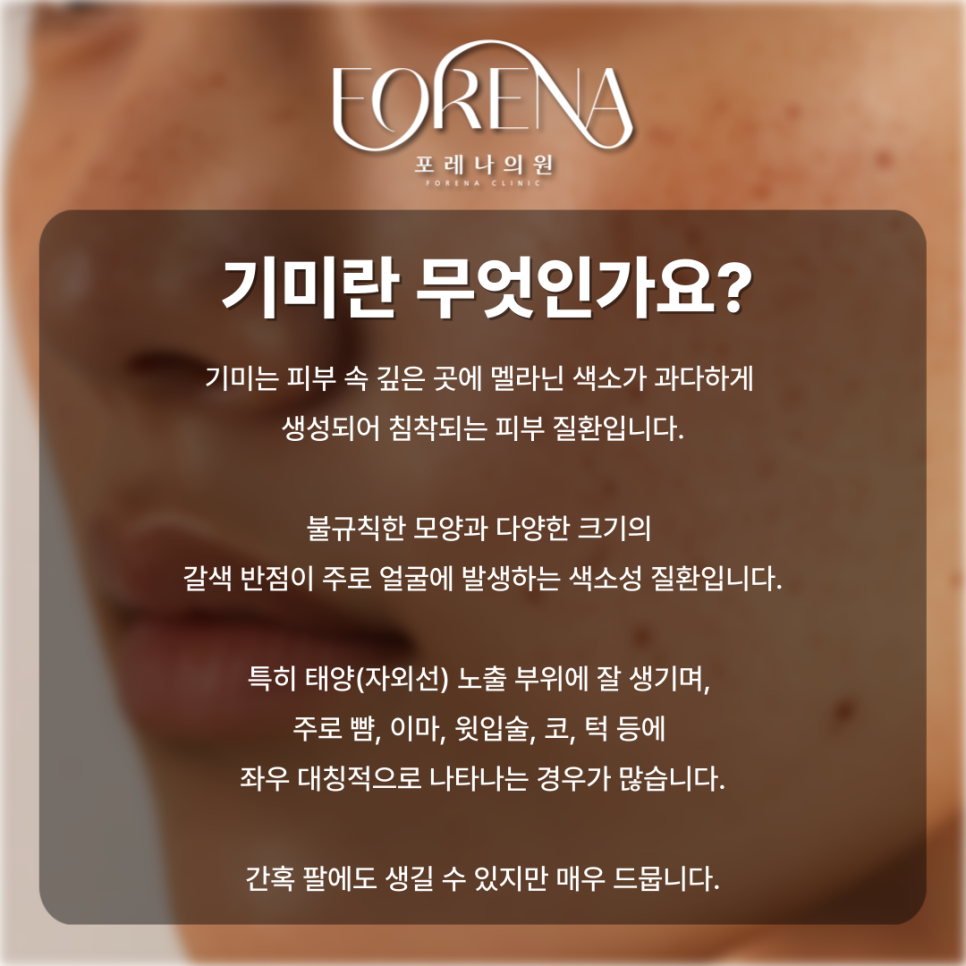 표피형, 진피형, 혼합형, 난치성 기미 고민 나한테 있는 기미는 어떤 종류일까?💧 관련 이미지 3