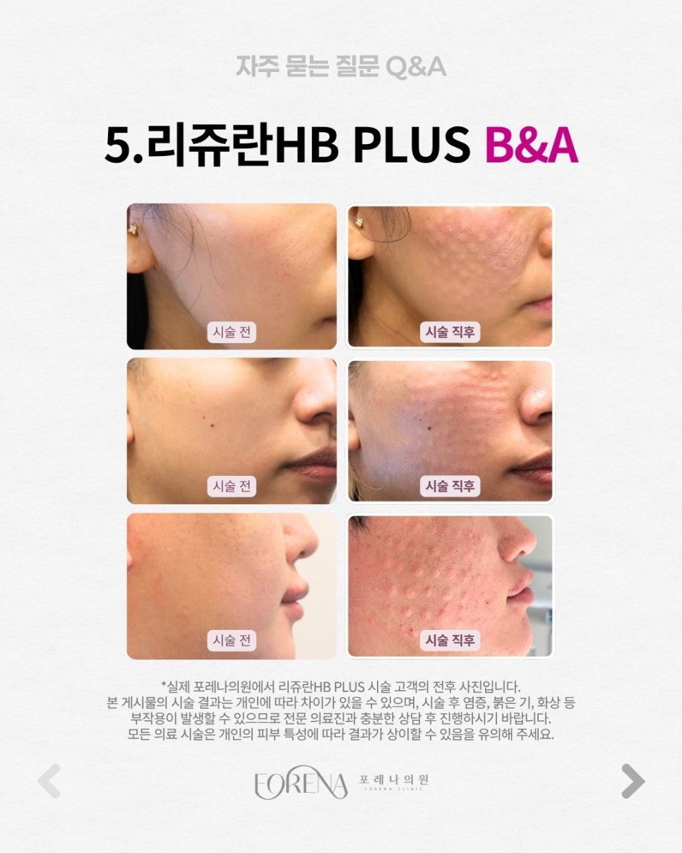 Rejuran HB PLUS Q&A | Procedure Principles and Features Summary image 6
