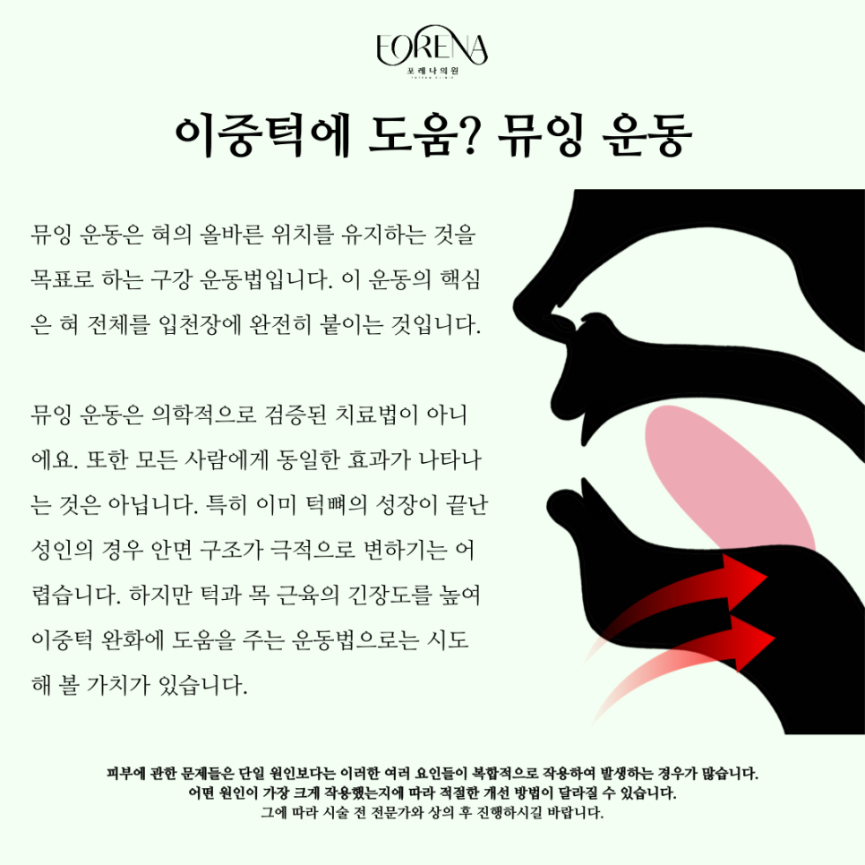 이중턱에 대한 자세한 내용부터 뮤잉 운동까지 알아보자! 관련 이미지 5