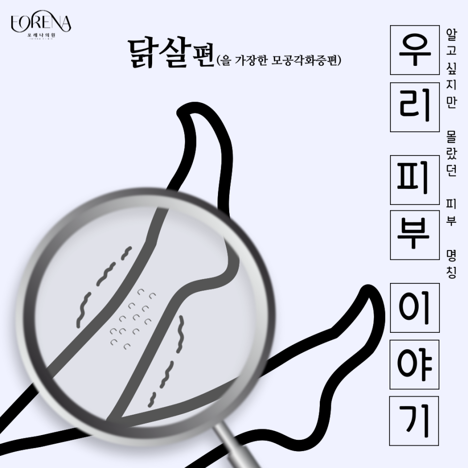 모공각화증이랑 닭살 돋는다 할때 닭살은 같은건가요?🐔 관련 이미지 2