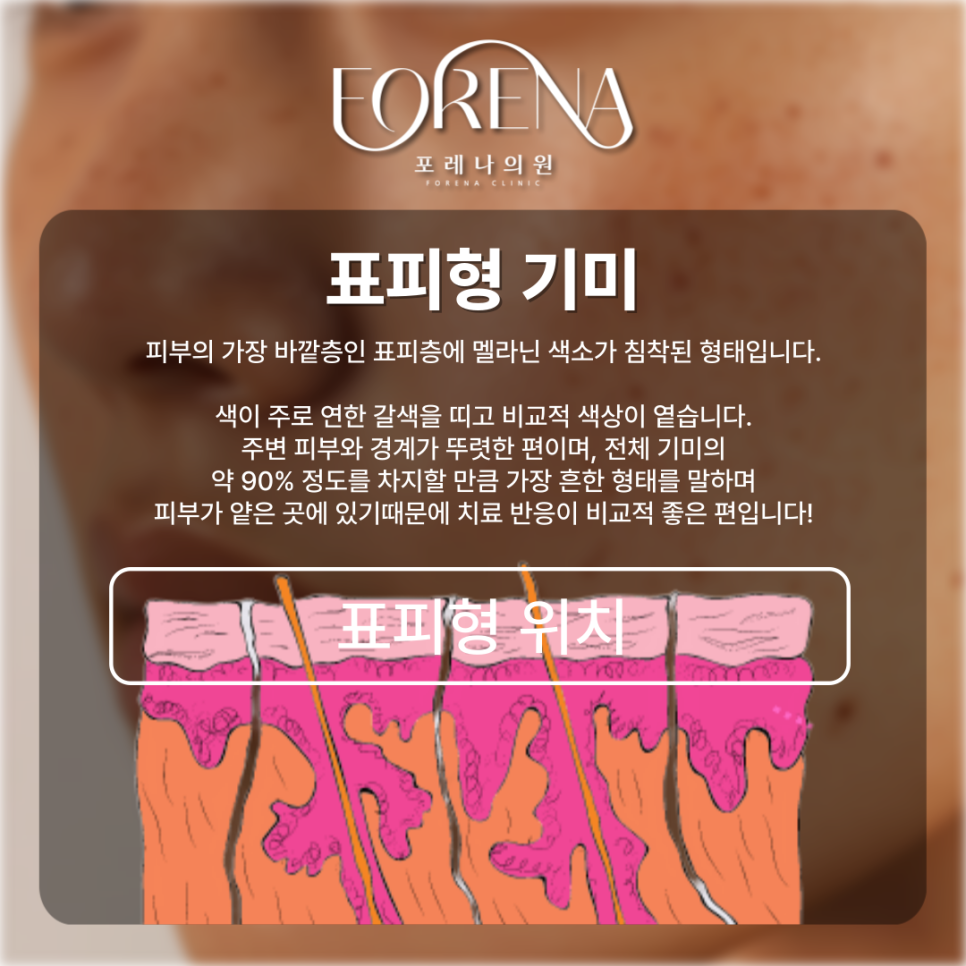 표피형, 진피형, 혼합형, 난치성 기미 고민 나한테 있는 기미는 어떤 종류일까?💧 관련 이미지 5