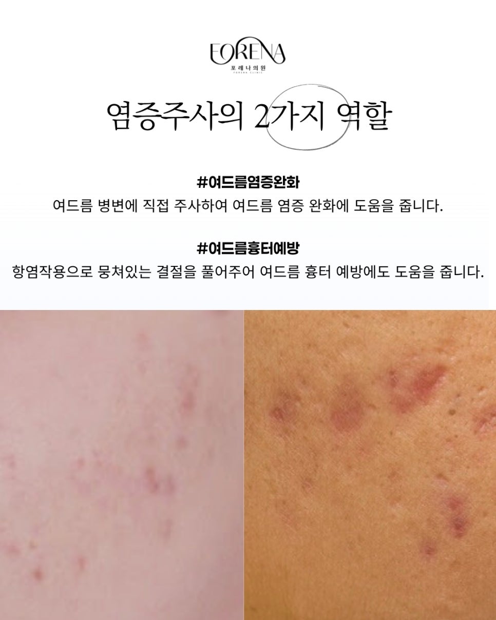 포레나 염증주사 어떤 시술일까요? 관련 이미지 3