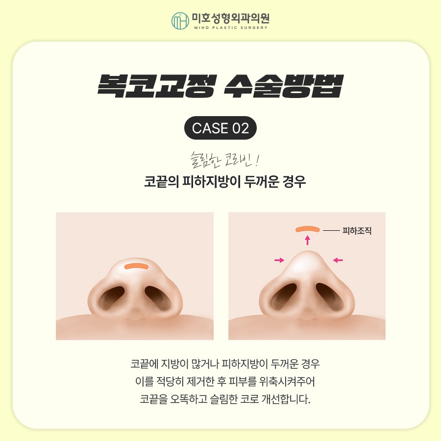 Naturally Improve the Bulbous Nose Complex image 5