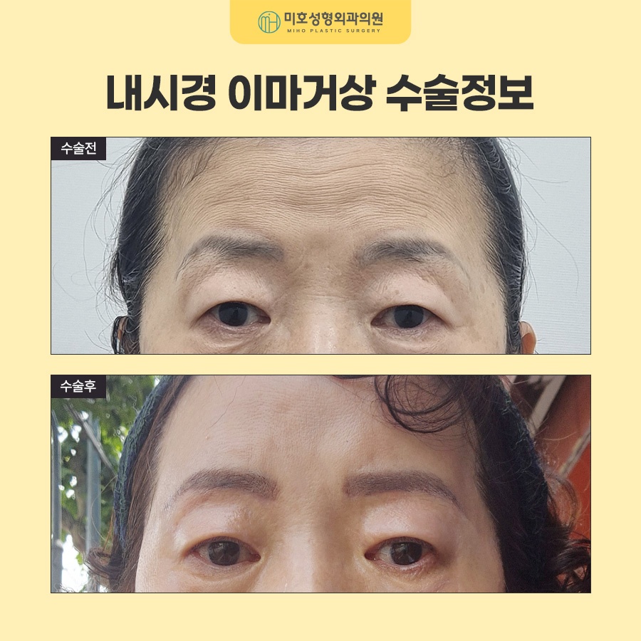 내시경이마거상 부기와 회복기간, 유지기간까지 알아보기 관련 이미지 8