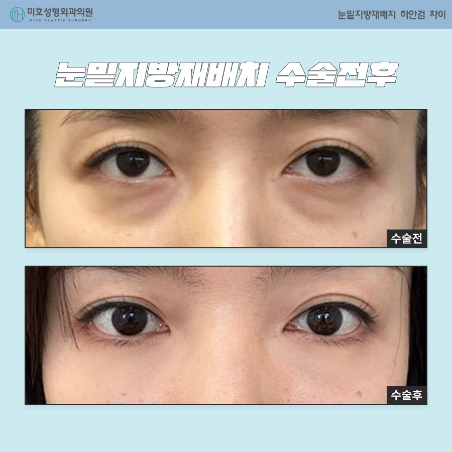 How to Choose Between Under-Eye Fat Repositioning and Lower Blepharoplasty image 8