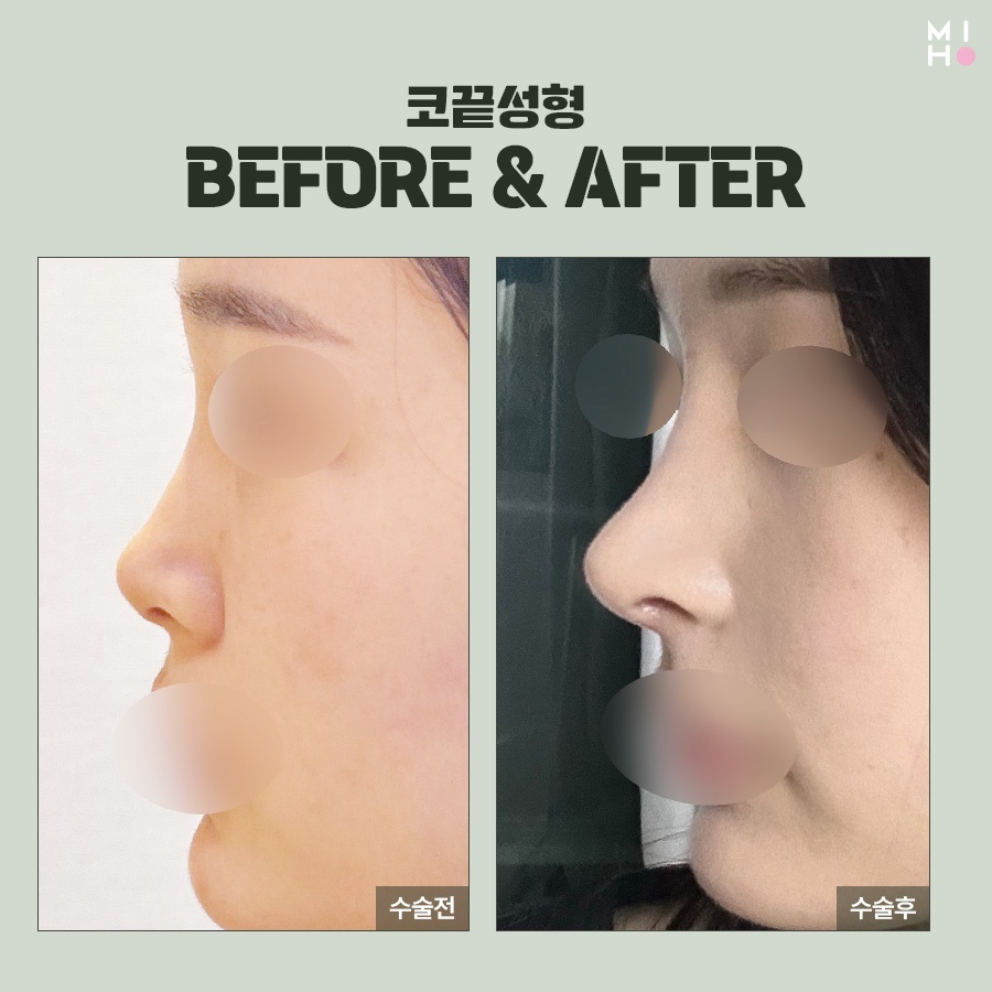 코끝연골묶기 복코 교정을 위한 과정 관련 이미지 8
