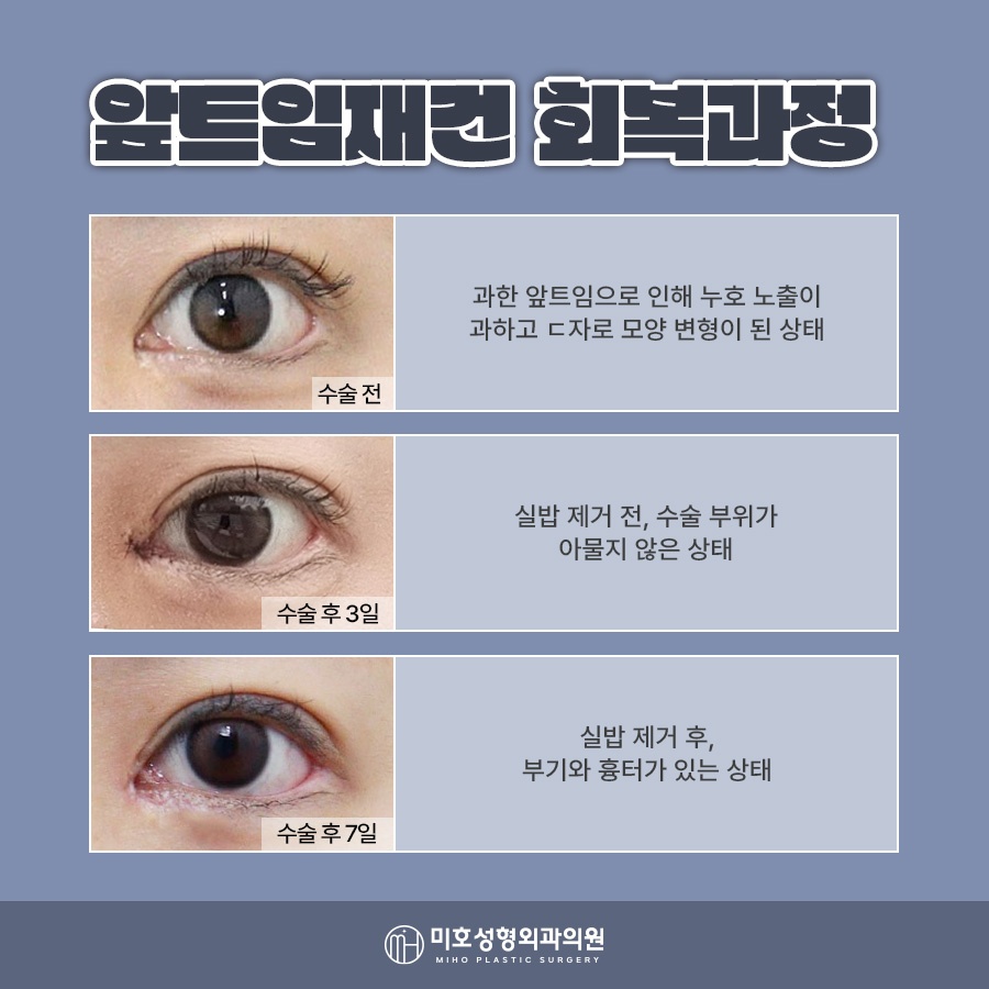 앞트임재건 미세함의 차이로 관련 이미지 6