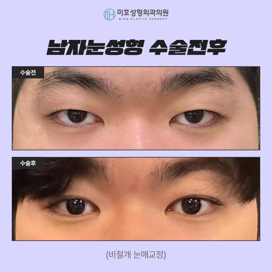 남자눈성형 무쌍눈매교정 특징 알아보기 관련 이미지 7