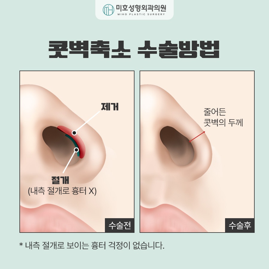 Comprehensive Guide to Alar Reduction Procedure and Aftercare image 3
