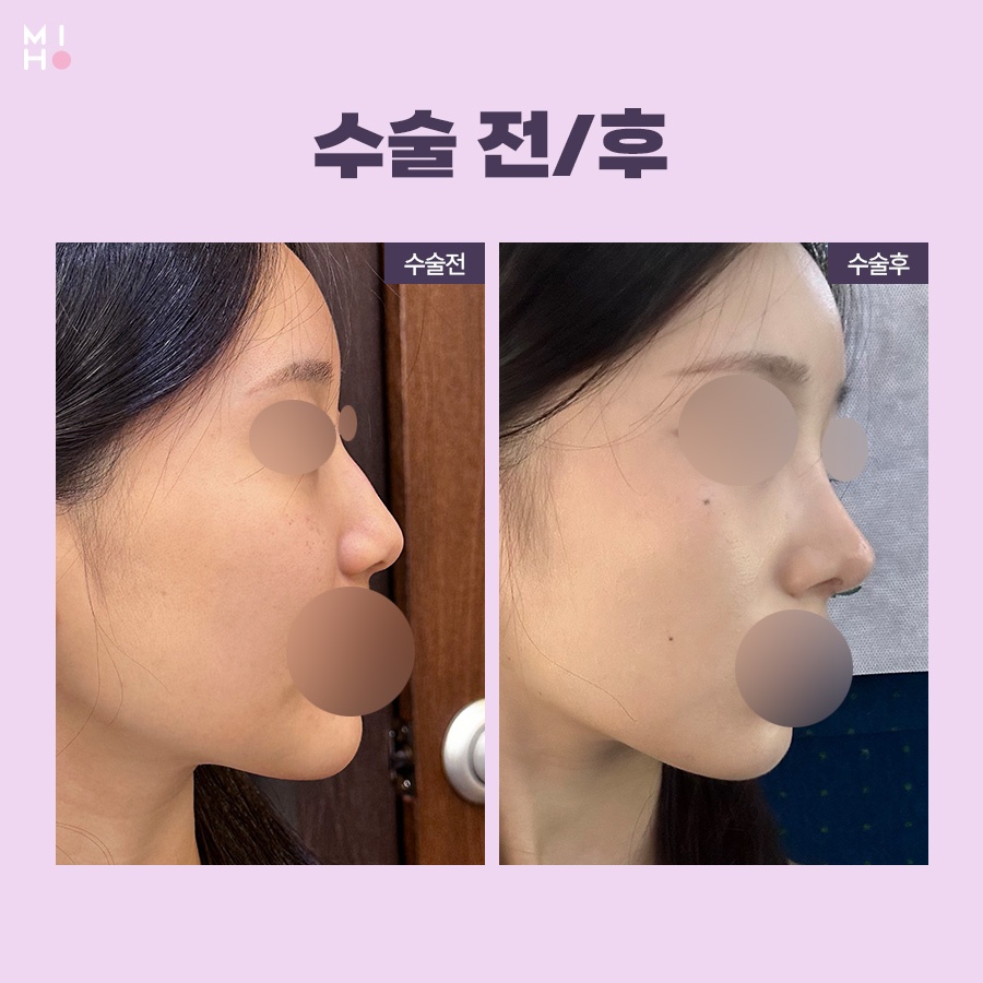 If You Are Curious About the Actual-Expense Insurance Claim Process for a Deviated Septum image 9