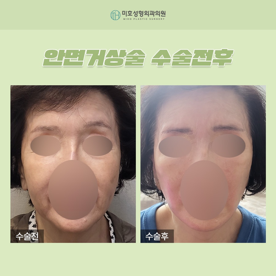 Wondering About the Side Effects of a Facelift? image 8