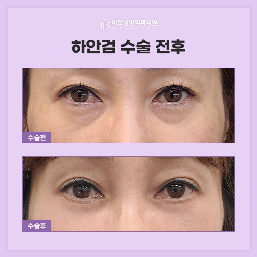 When Is Lateral Canthal Fixation Needed with Lower Blepharoplasty? image 7