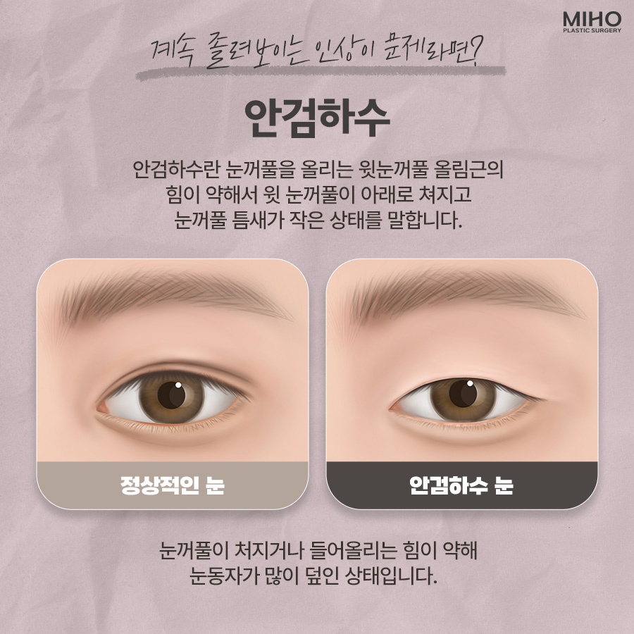 안검하수 발생 요인과 증상에 맞춰 관련 이미지 2