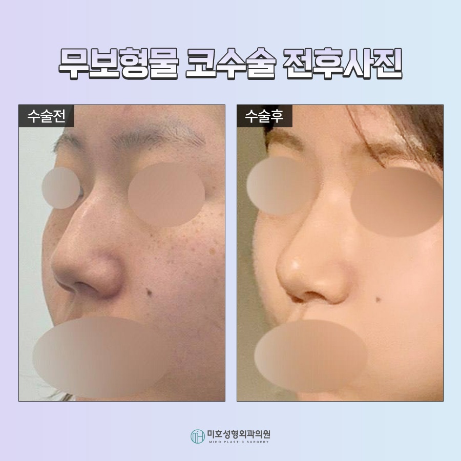A Natural Nose Using Autologous Tissue: Implant-Free Rhinoplasty image 9