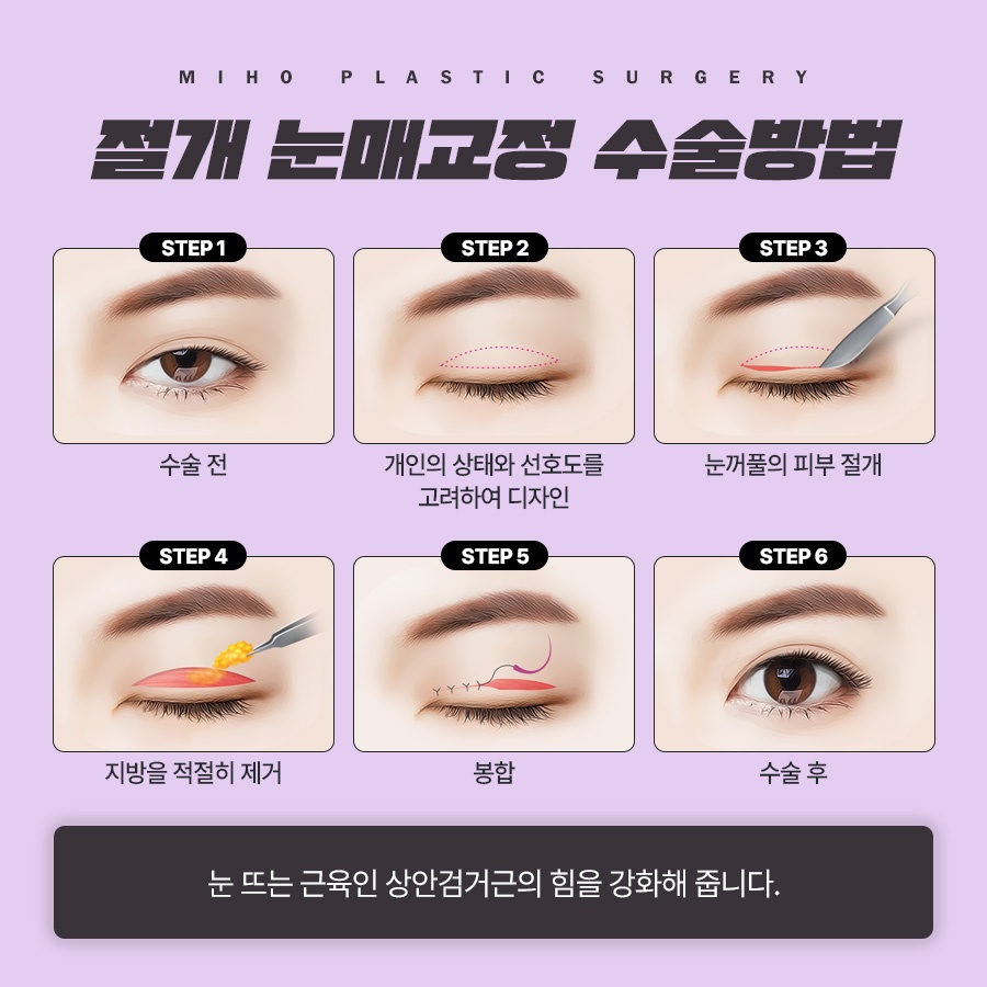 The Key to a Natural Image Transformation with Male Eyelid Surgery image 5