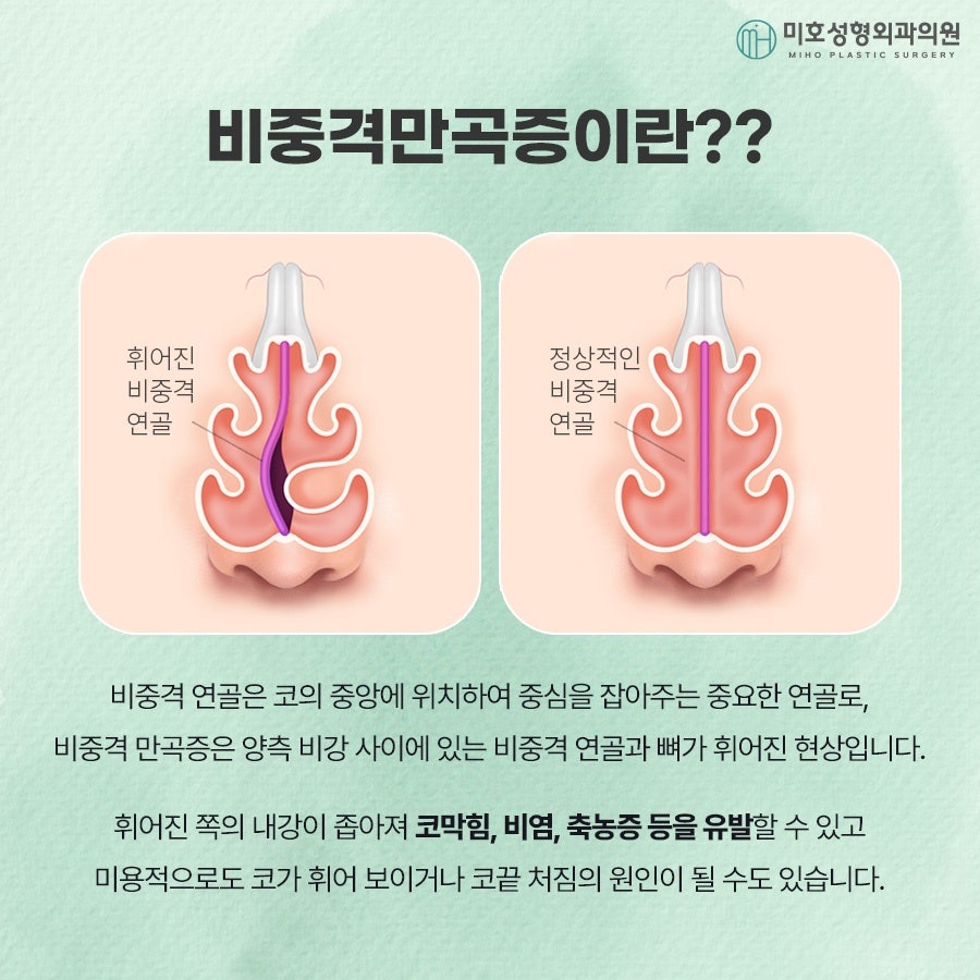 The Progression of a Deviated Nasal Septum and Precautions image 16