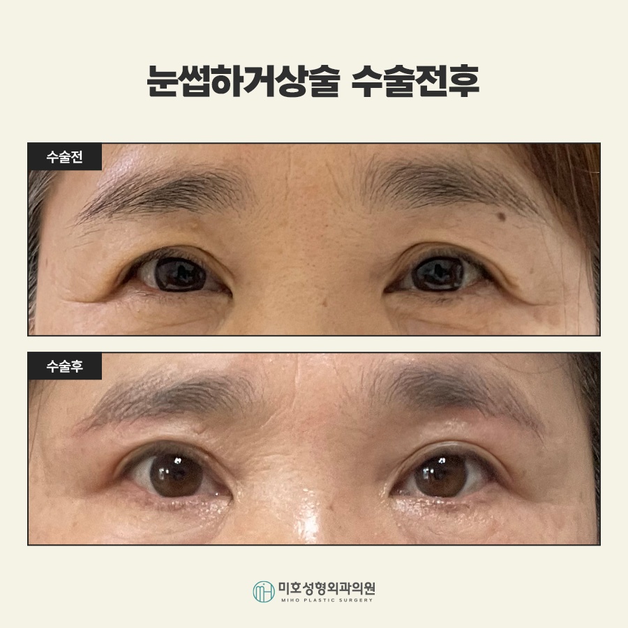 Sub-Brow Lift for Softening a Heavy Appearance image 8