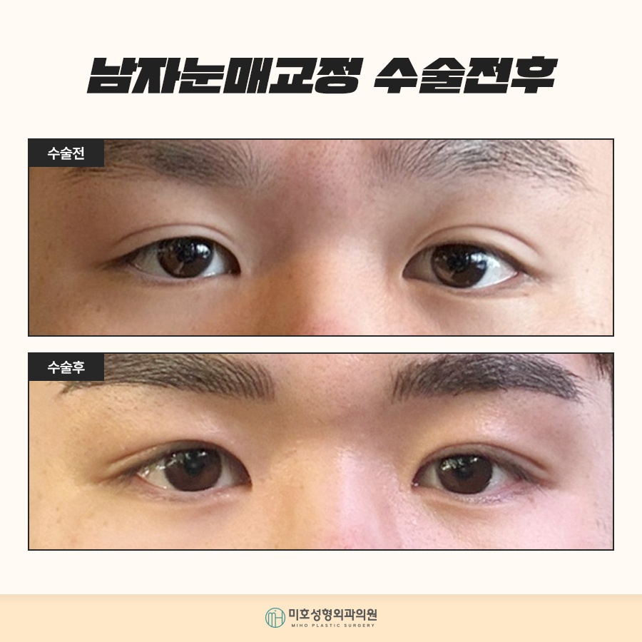 남자눈매교정 자연스러운 이미지로 관련 이미지 8