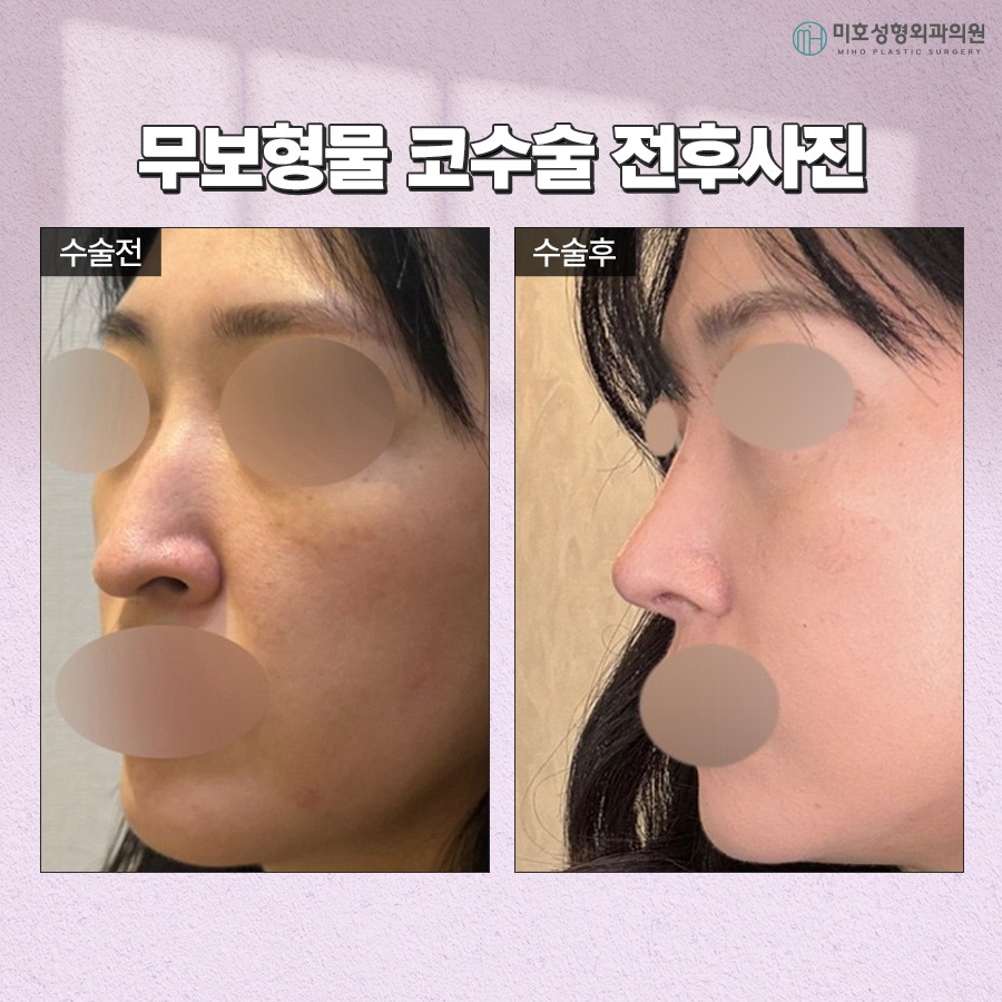 Criteria for Choosing Natural-Looking Implant-Free Rhinoplasty image 7