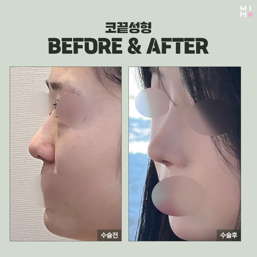 코끝연골묶기 복코 교정을 위한 과정 관련 이미지 12