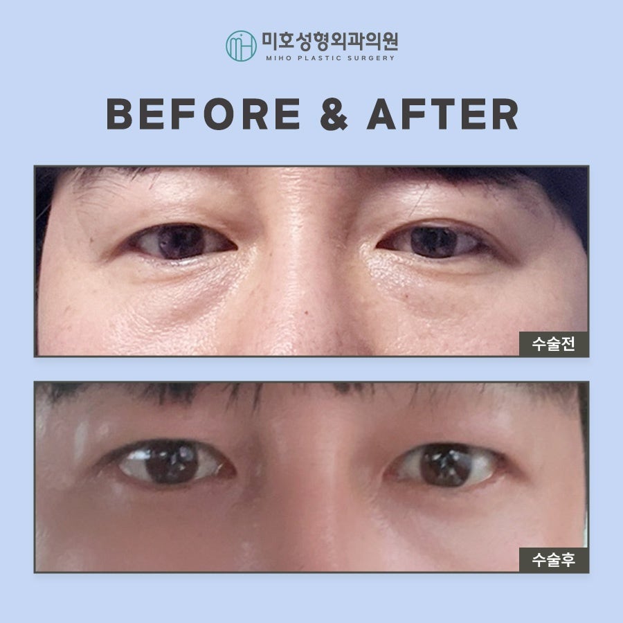 Miho Signature Lower Eyelid Fat Repositioning: The Beginning of Youth image 24