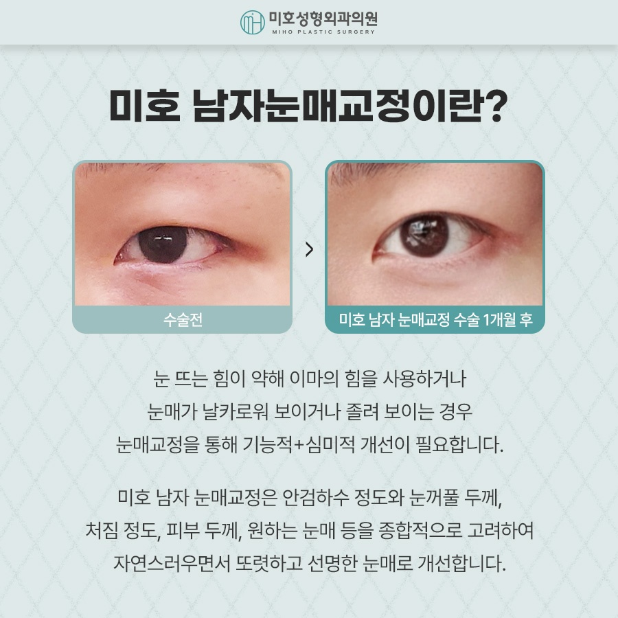 Naturally Defined Eyes with Male Eye-Shape Correction image 2
