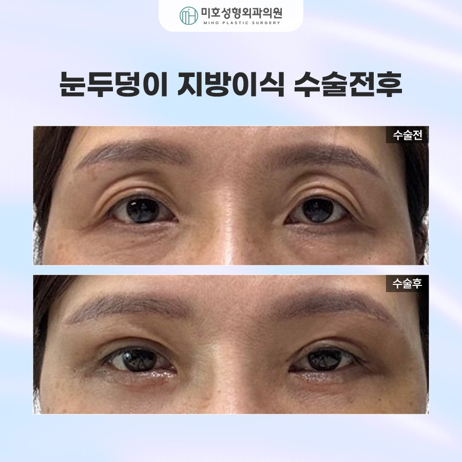 Upper Eyelid Fat Grafting to Improve Hollow Eyes and Make Them Look More Lively image 6