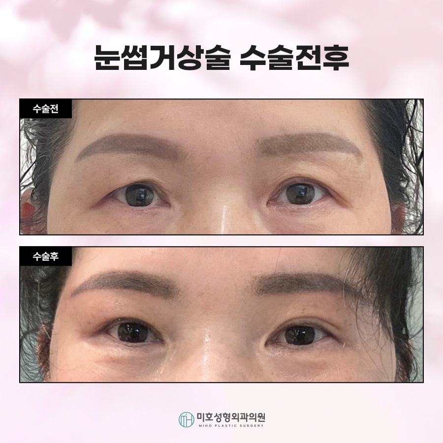 눈썹거상후기 속 주인공이 되는 법 관련 이미지 8