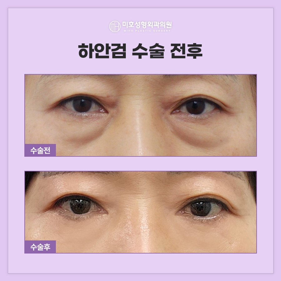 When Is Lateral Canthal Fixation Needed with Lower Blepharoplasty? image 9