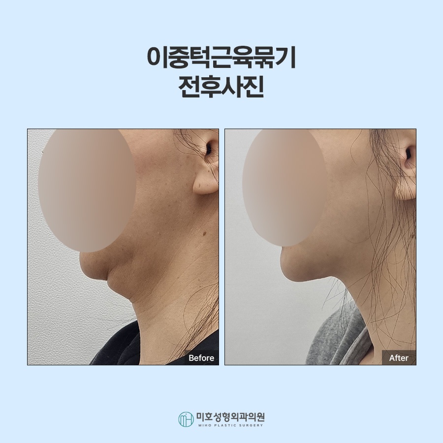 If the Jawline Beneath the Chin Looks Blurred: Double-Chin Muscle Tightening image 7