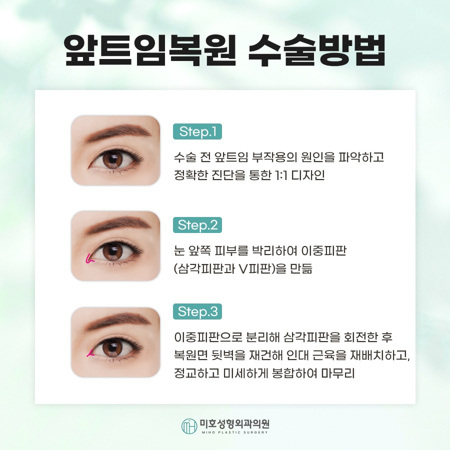 How Medial Canthoplasty Restoration Is Performed and Scar Care image 3