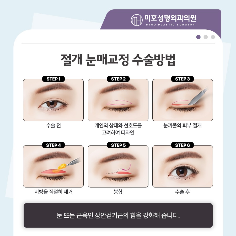 Focusing on a Natural Look in Male Eye Surgery image 6
