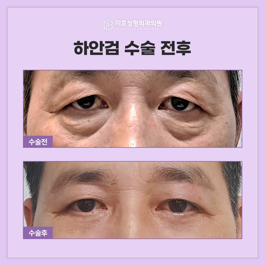 When Is Lateral Canthal Fixation Needed with Lower Blepharoplasty? image 8