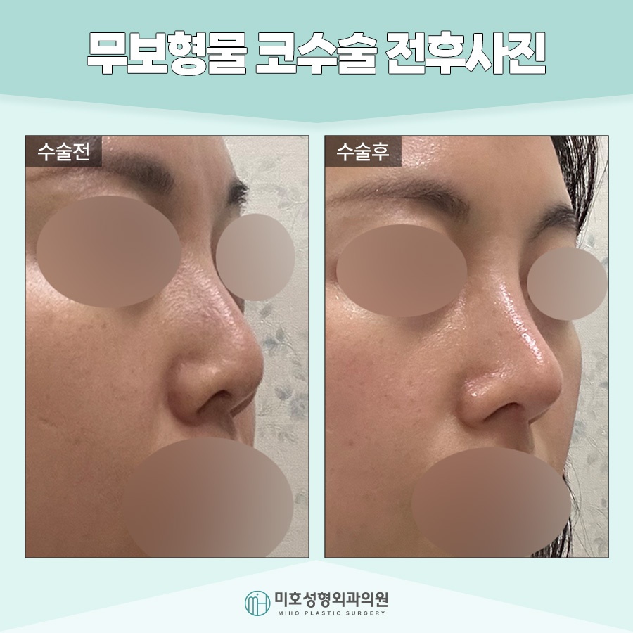 무보형물코수술 자연스러운 라인을 원한다면 관련 이미지 10