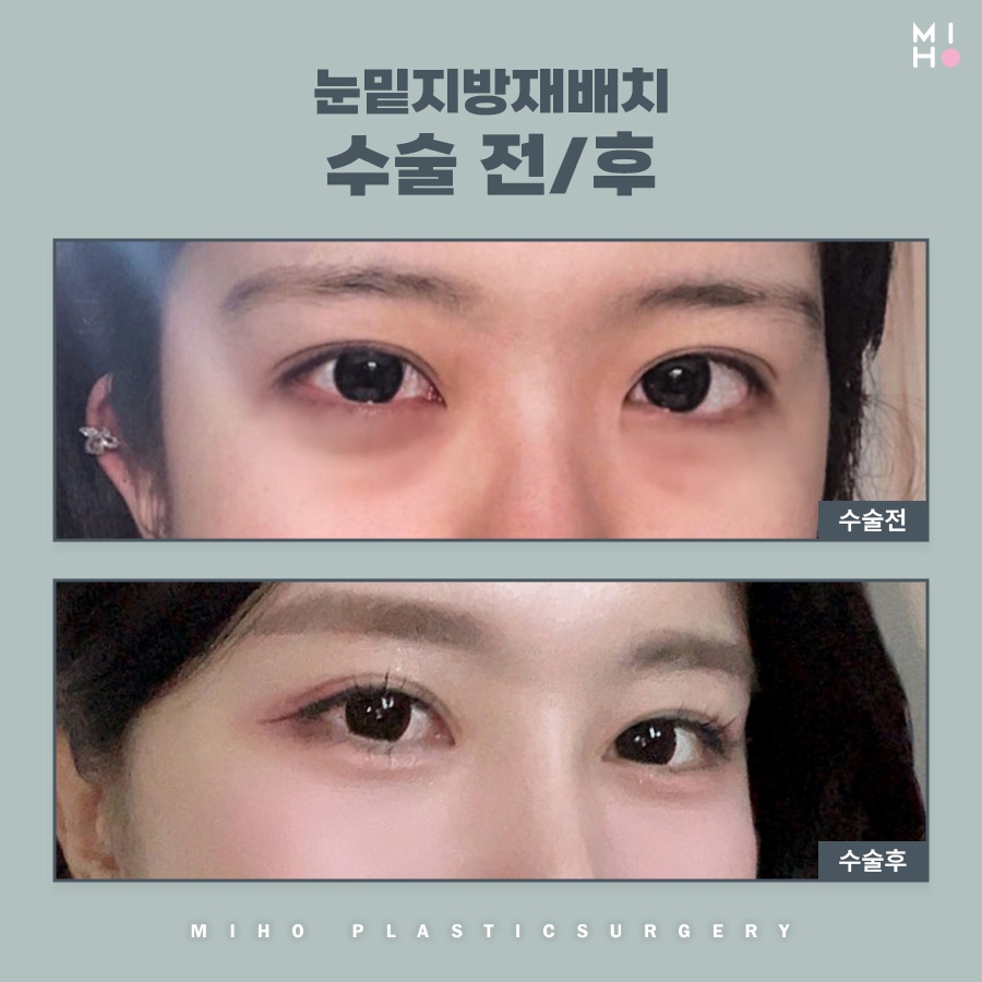 눈밑지방재배치 호감형 인상으로 개선하려면 관련 이미지 9