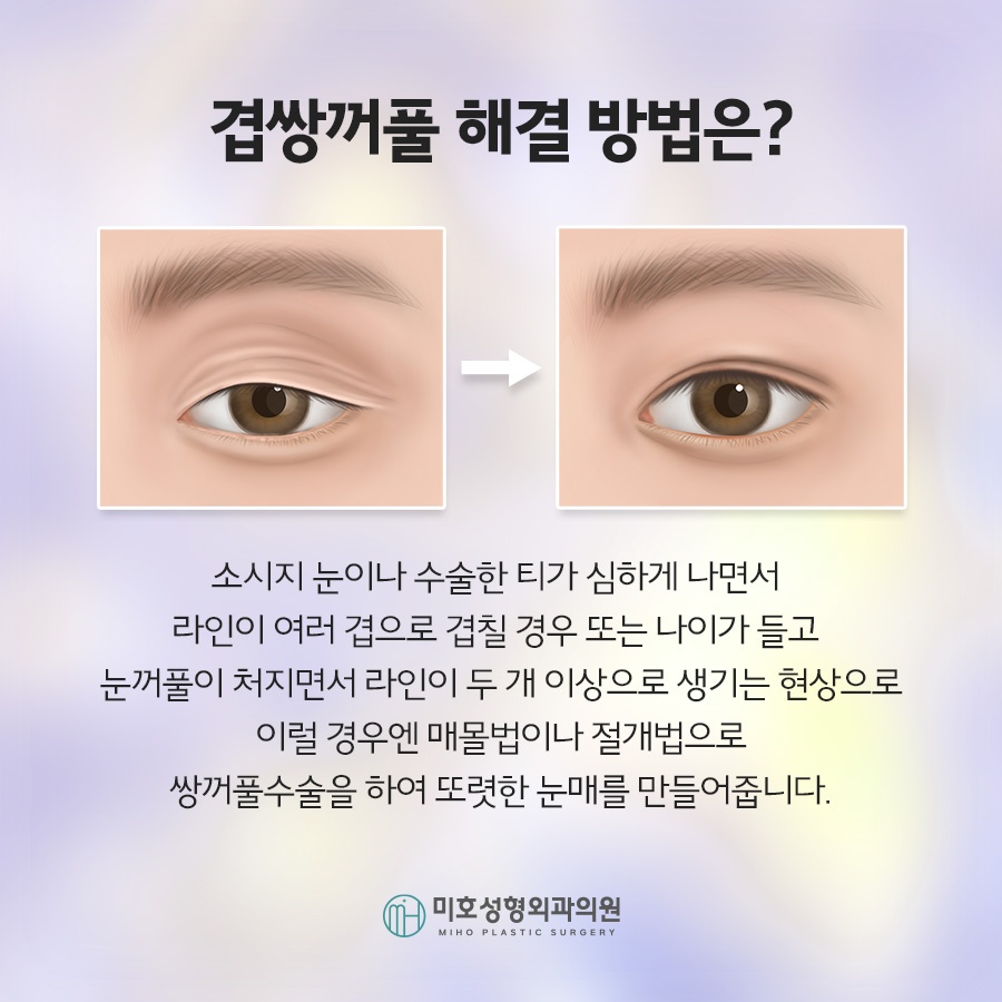 겹쌍꺼풀 깔끔하게 정돈하려면 관련 이미지 5