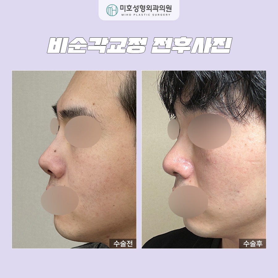 Nasolabial Angle Correction: Who Needs It and How Should It Be Done? image 8