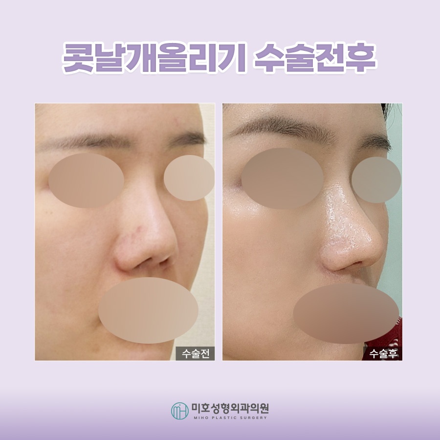콧날개올리기 개개인에게 맞는 방식으로 관련 이미지 10