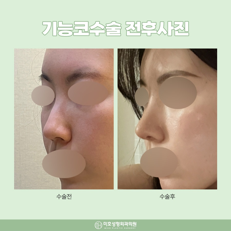 하비갑개절제술 코막힘 개선 방법 관련 이미지 9