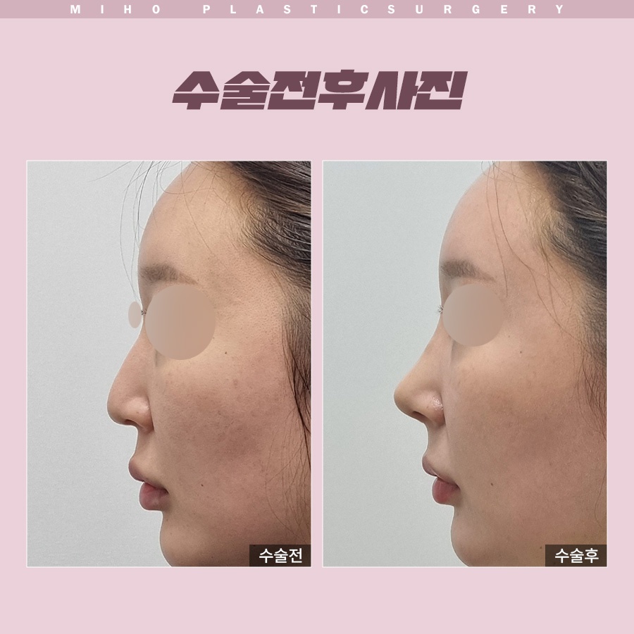 화살코 개선 전 체크리스트 6가지 관련 이미지 6