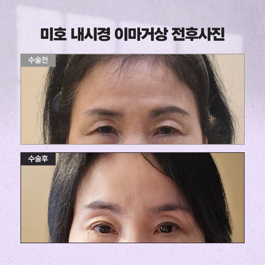 내시경이마거상 처짐 개선 원리 관련 이미지 10