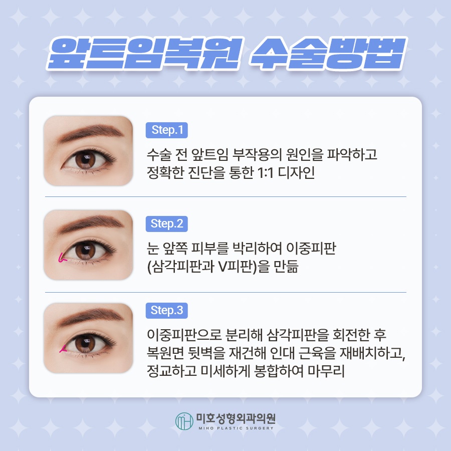 앞트임복원 제대로 알기 관련 이미지 3