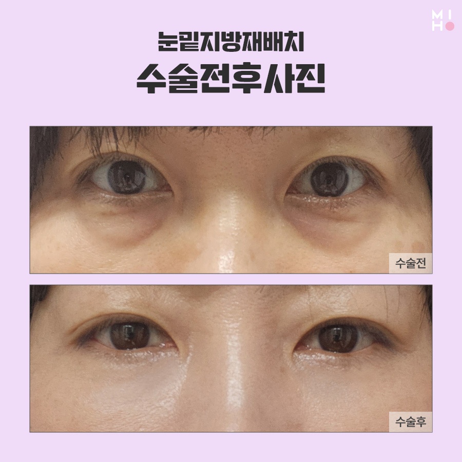 눈밑지방재배치 보완할 곳을 파악하여 관련 이미지 8