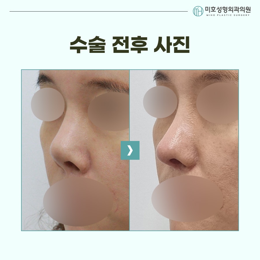 Natural Correction of an Upturned Nose image 9