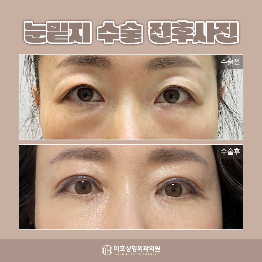 눈밑지붓기 원인 기간을 고려하여 관련 이미지 9
