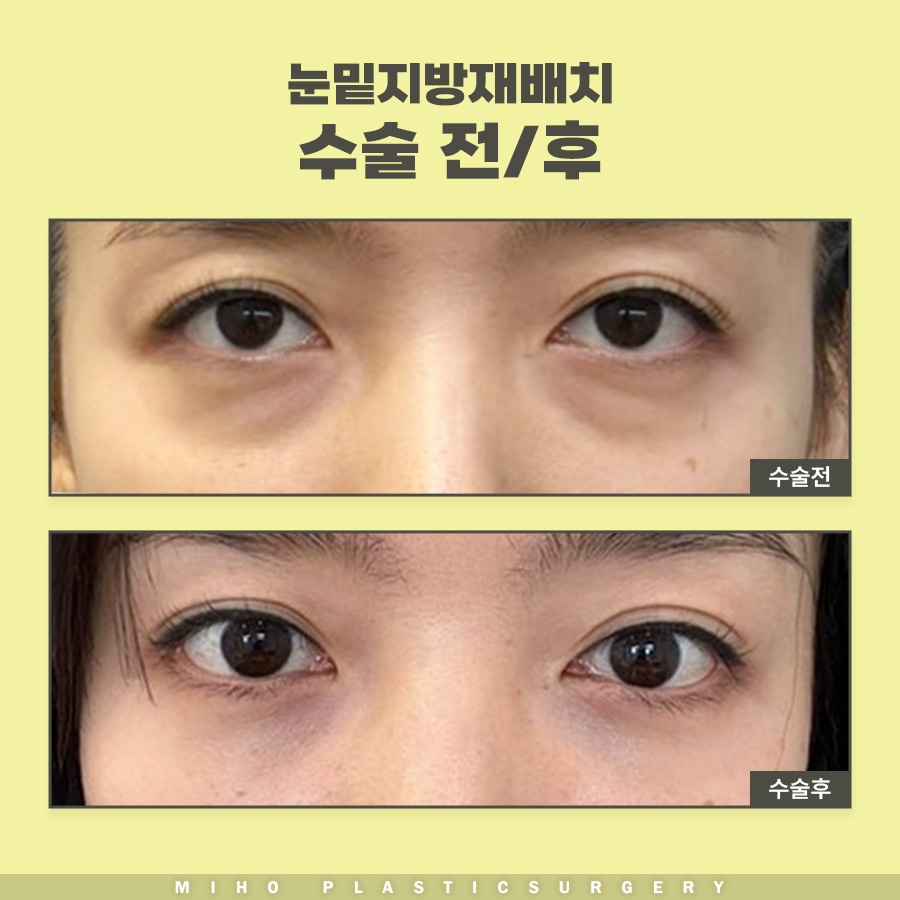 눈밑지방재배치수술비용 내게 맞는 수준은 관련 이미지 7