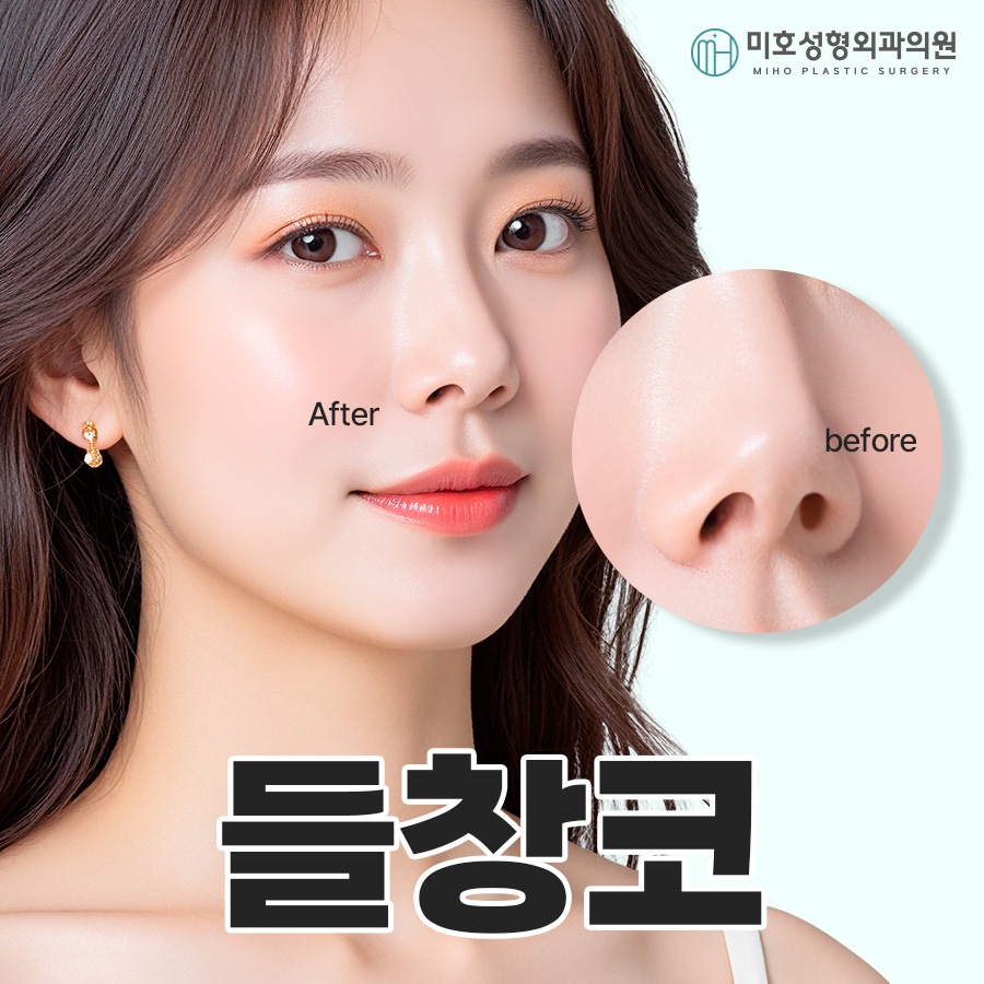 Natural Correction of an Upturned Nose image 1